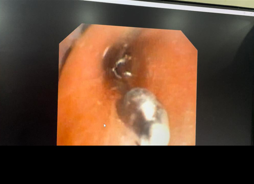 Foreign body removal