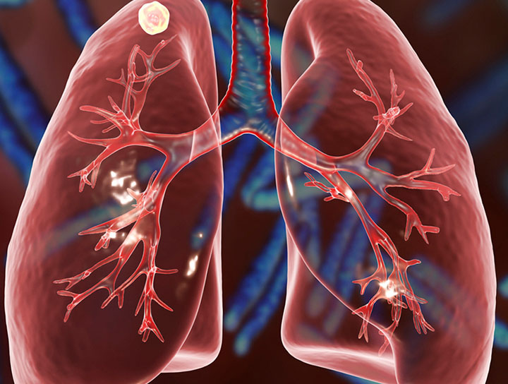 Biopsy of Lung or Lymph Node