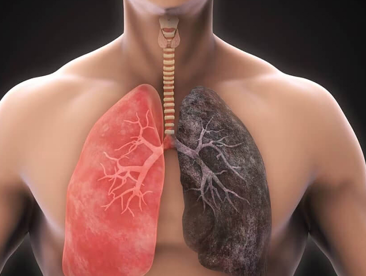 COPD