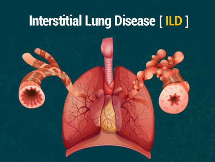 Interstitial Lung Disease