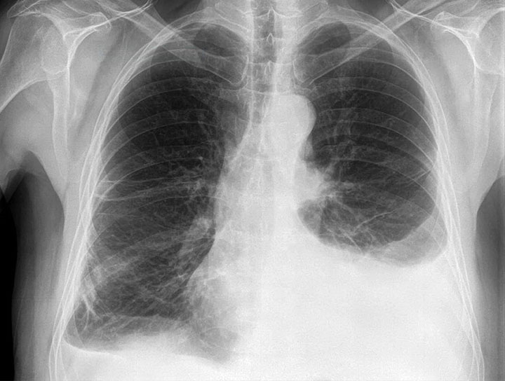 Pleural Effusion
