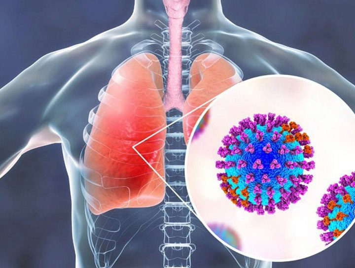 Pneumonia