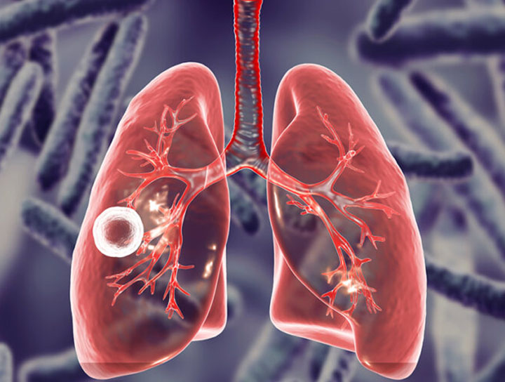 Tuberculosis